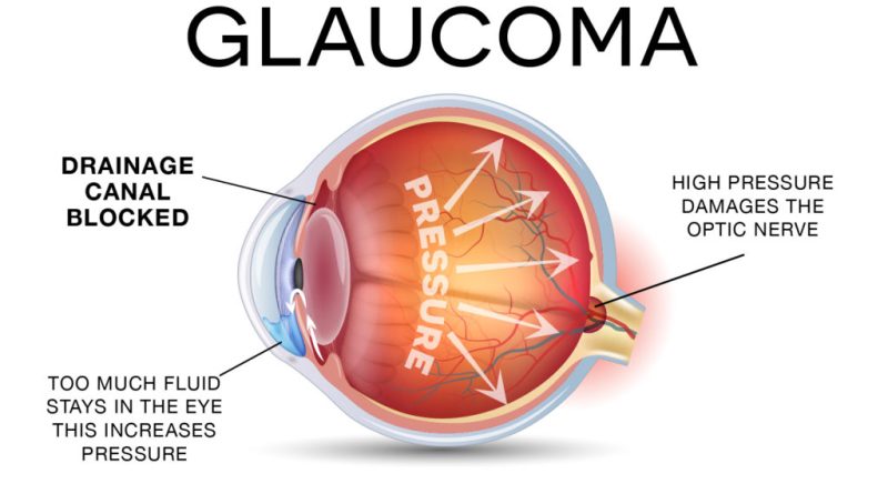 Glaucoma